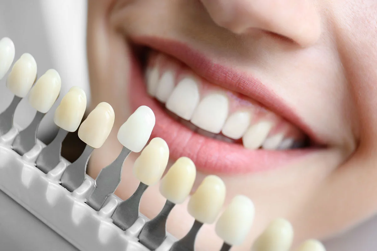 Blanqueamiento dental Mallo Gallego